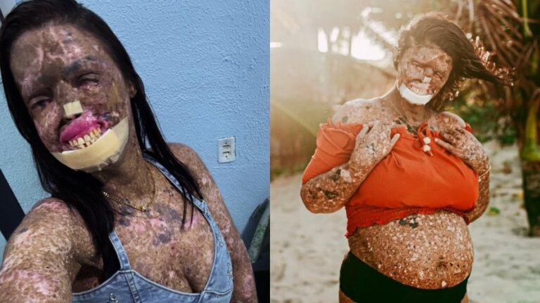 morre-kah-felipe,-influenciadora-que-convivia-com-doenca-rara-e-cancer-terminal