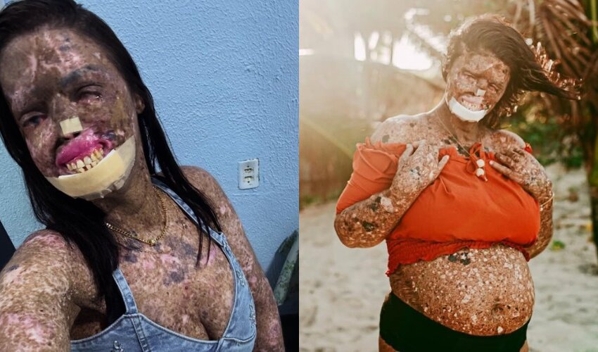 morre-kah-felipe,-influenciadora-que-convivia-com-doenca-rara-e-cancer-terminal