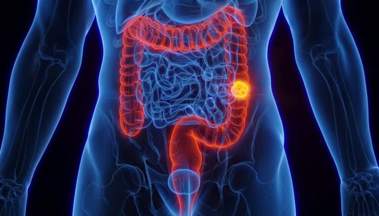 sus-passa-a-oferecer-novo-exame-de-alta-tecnologia-para-detectar-cancer-colorretal-antes-dos-sintomas
