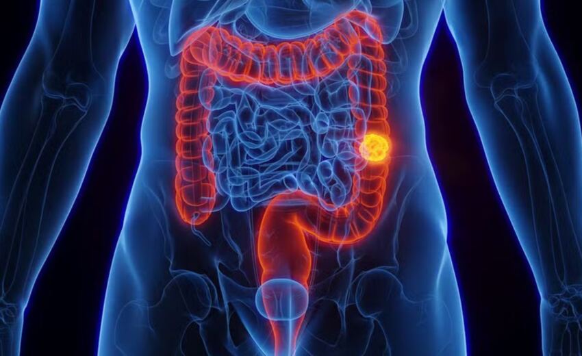 sus-passa-a-oferecer-novo-exame-de-alta-tecnologia-para-detectar-cancer-colorretal-antes-dos-sintomas